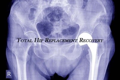 Total Hip Replacement Recovery & Surgery Complication | Dr. Vinil Shinde