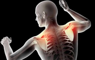 Is a Pinched Nerve Causing Your Shoulder Pain?