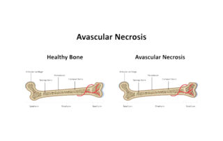 Best Clinic to cure Avascular Necrosis in Pune - Chirayu Clinic Kothrud