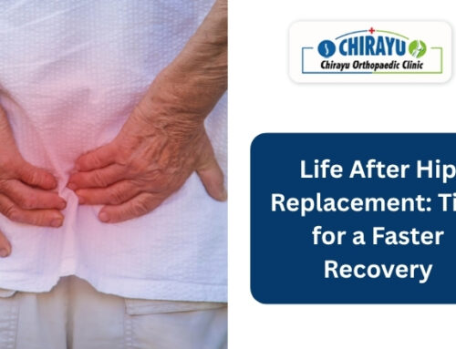Life After Hip Replacement: Tips for a Faster Recovery